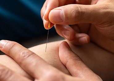 Dry Needling bij Fysiotherapie RijswijkBuiten